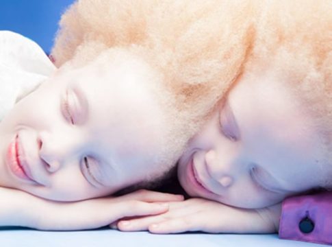 Empowerment And Equality: Albinos In Osun Call For Change