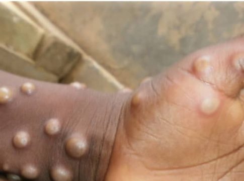 171 Cases Of Mpox Confirmed In Burundi