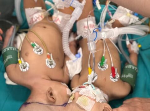 Indian Surgeon Successfully Separates Conjoined Twins