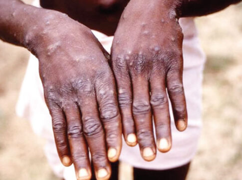 Plateau State Announces Discharge Of Five Mpox Patients